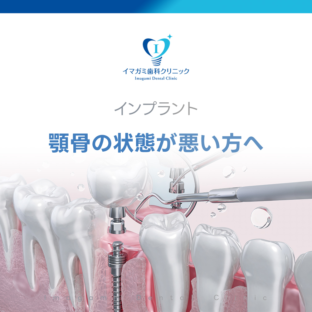 IDCインプラント