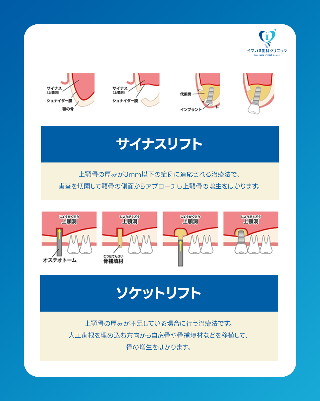 IDCインプラント